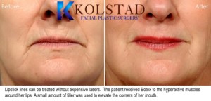 Lipstick lines lip botox best filler doctor la jolla elevate corners of mouth specialist plastic surgery