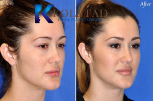 liquid cheek augmentation filler juvederm cost price voluma injections san diego la jolla
