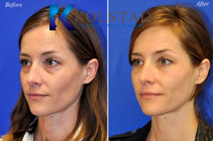 liquid eyelift injections filler tear trough dark circles cost best injector san diego la jolla del mar