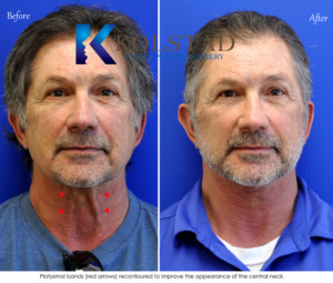 male facelift san diego