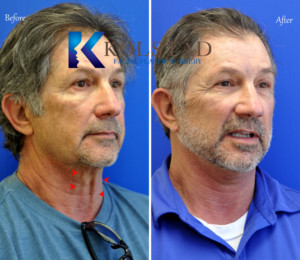 male facelift san diego