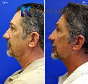 male facelift san diego 6