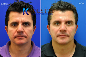 male radiesse san diego filler specialist natural artistic rejuvenation antiaging