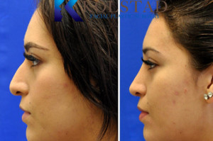 mexican rhinoplasty san diego