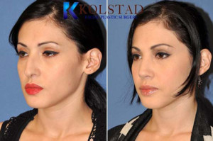 mexican rhinoplasty san diego