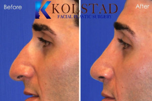 middle eastern rhinoplasty