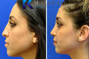 middle eastern rhinoplasty san diego