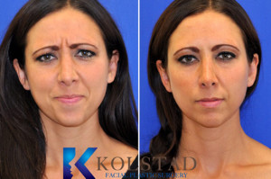 natural botox 11s glabella forehead wrinkles preventative la jolla san diego top doctor plastic surgeon