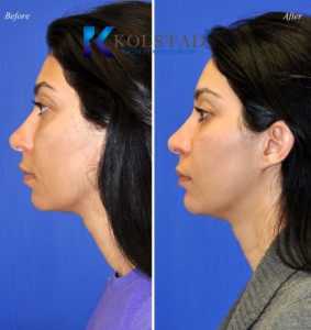 natural volume correction eyebags dark under eye circles filler injections radiesse cheek augmentation