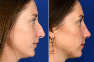 nose job san diego