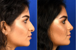 nose job san diego ethnic