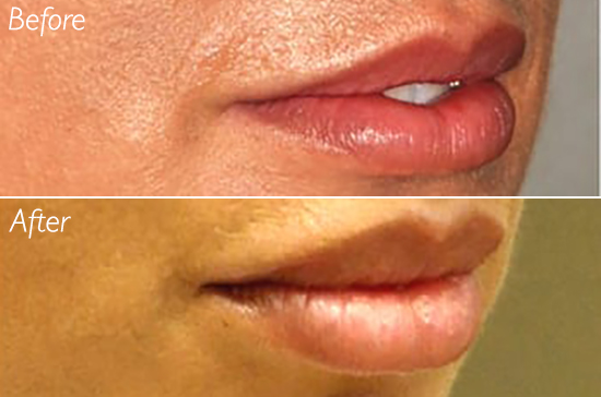 revision lip filler restylane lips augmentation enhancement top filler injector san diego del mar