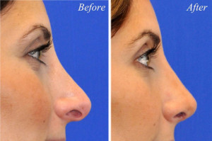 revision rhinoplasty san diego