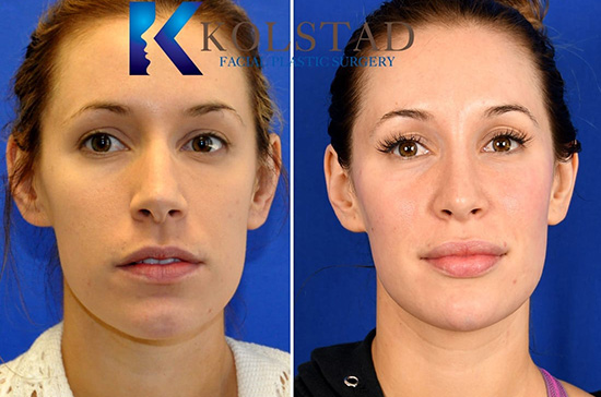 rhinoplasty before and after la jolla top surgeon