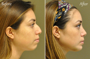 rhinoplasty san diego