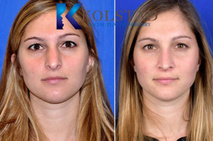 rhinoplasty san diego