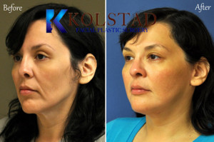 San Diego Facelift