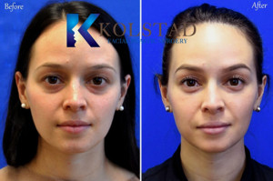 tear trough filler injections cost dark circles Restylane Vollure under eyes san diego