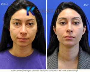 tear trough volume correction injectable fillers specialist san diego lower blepharoplasty eyelid surgery
