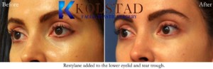 under eye filler tear troughs restylane cosmetic injections treatment antiaging rejuvenation refresh lower eyes