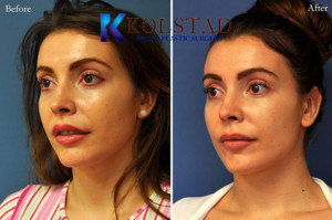 voluma juvederm restylane cheek filler augmentation dark circles undereye injections san diego la jolla