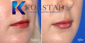 juvederm lips san diego la jolla carmel valley best lip augmention natural results nonsurgical
