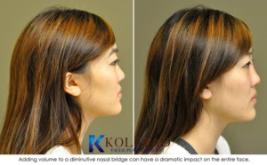 asian rhinoplasty san diego la jolla carlsbad non surgical nose job injectable filler cost pricing specials
