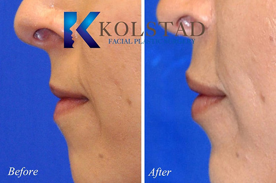 beautiful natural lip augmentatinon injectable dermal fillers fuller shape perfect pout best results