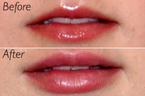 best lip augmentation san diego