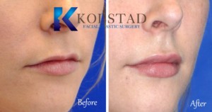 best lip augmentation san diego top filler injector natural enhancement juvederm price specials
