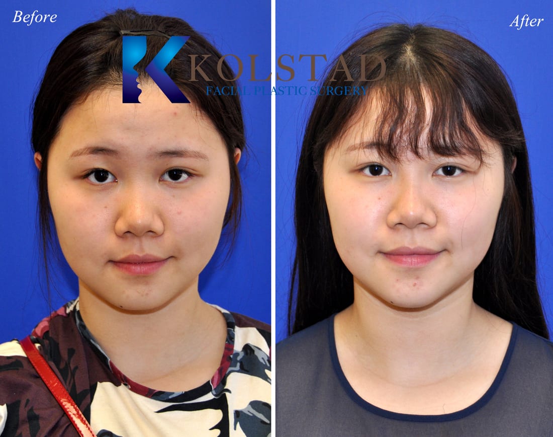 rhinoplasty before and after flat nose