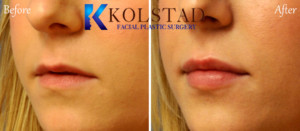 del mar la jolla aesthetic lip filler injector natural results top facial plastic surgeon fuller lips