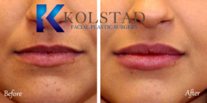 injectable lip filler specialist san diego la jolla carmel valley aesthetic cosmetic rejuvenation natural