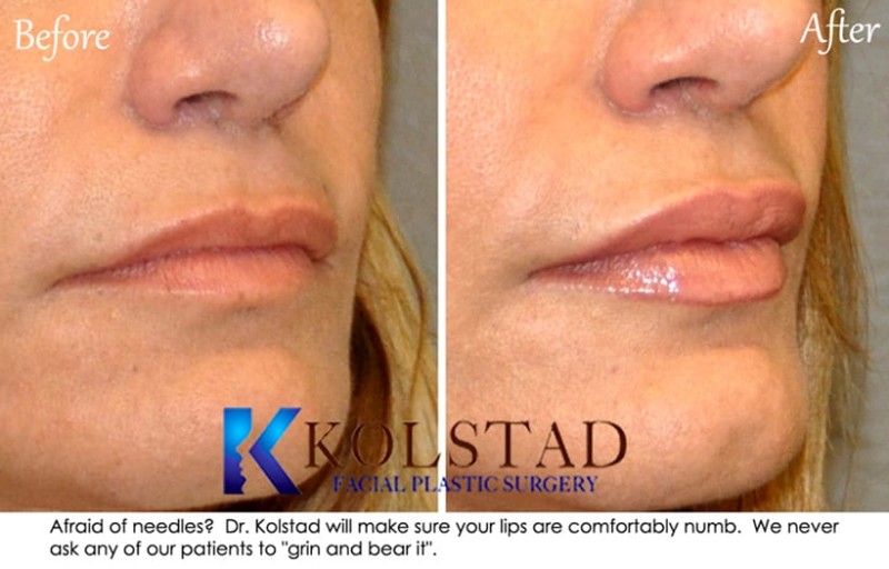 juvederm-lip-fillers-best-filler-injector-san-diego-la-jolla-carlsbad ...