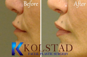 juvederm lips filler augmentation