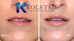 la jolla del mar thin lip fillers injectable juvederm restylane best injector facial plastic surgery natural