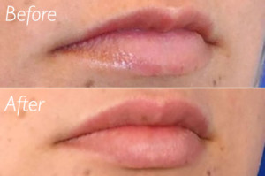 juvederm vollure volbella cost