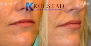 lip augmentation la jolla carlsbad encinitas top filler injector plastic surgery natural beautiful lips