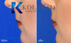 lip augmentation la jolla del mar carlsbad nonsurgical injectable cosmetic natural before after