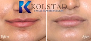 lip augmentation san diego best filler injector doctor natural results fuller lips pretty pout