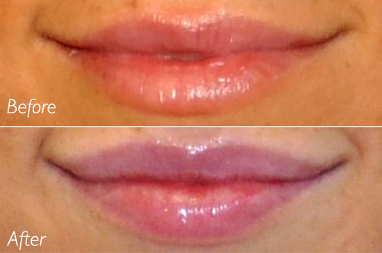 lip augmentation san