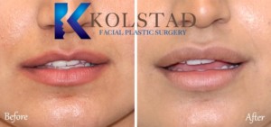 facial plastic surgery results before after photos
