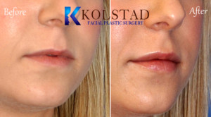 lip filler carmel valley la jolla solana beach top facial plastic surgery beautiful lips natural result