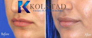 lip filler san diego la jolla del mar natural results fuller lips pout augmentation enhancement