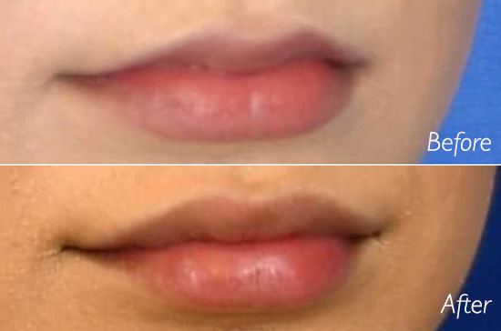 lip injections near me