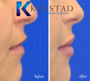 lip filler specialist top facial plastic surgeon natural beautiful cosmetic treatment san diego la jolla