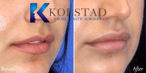 lip injection san diego carlsbad del mar expert filler injector top doctor best plastic surgery