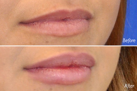 lip injections san diego
