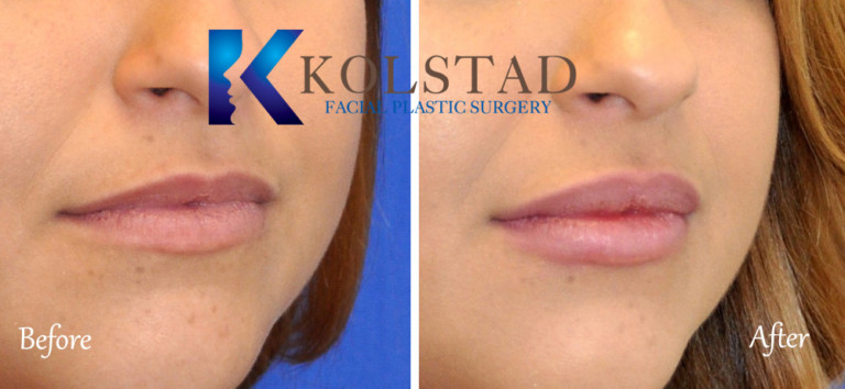 lip-injections-san-diego-solana-beach-del-mar-best-facial-plastic ...