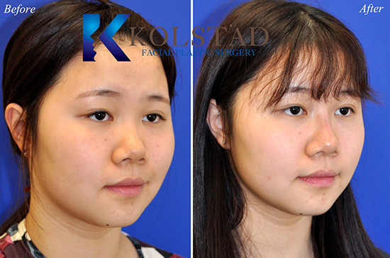 Liquid Rhinoplasty Results | Dr. Kolstad - San Diego Facial Plastic Surgeon